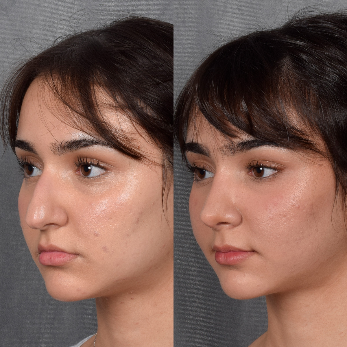 Rhinoplasty Before & After Gallery - Patient 692414 - Image 3