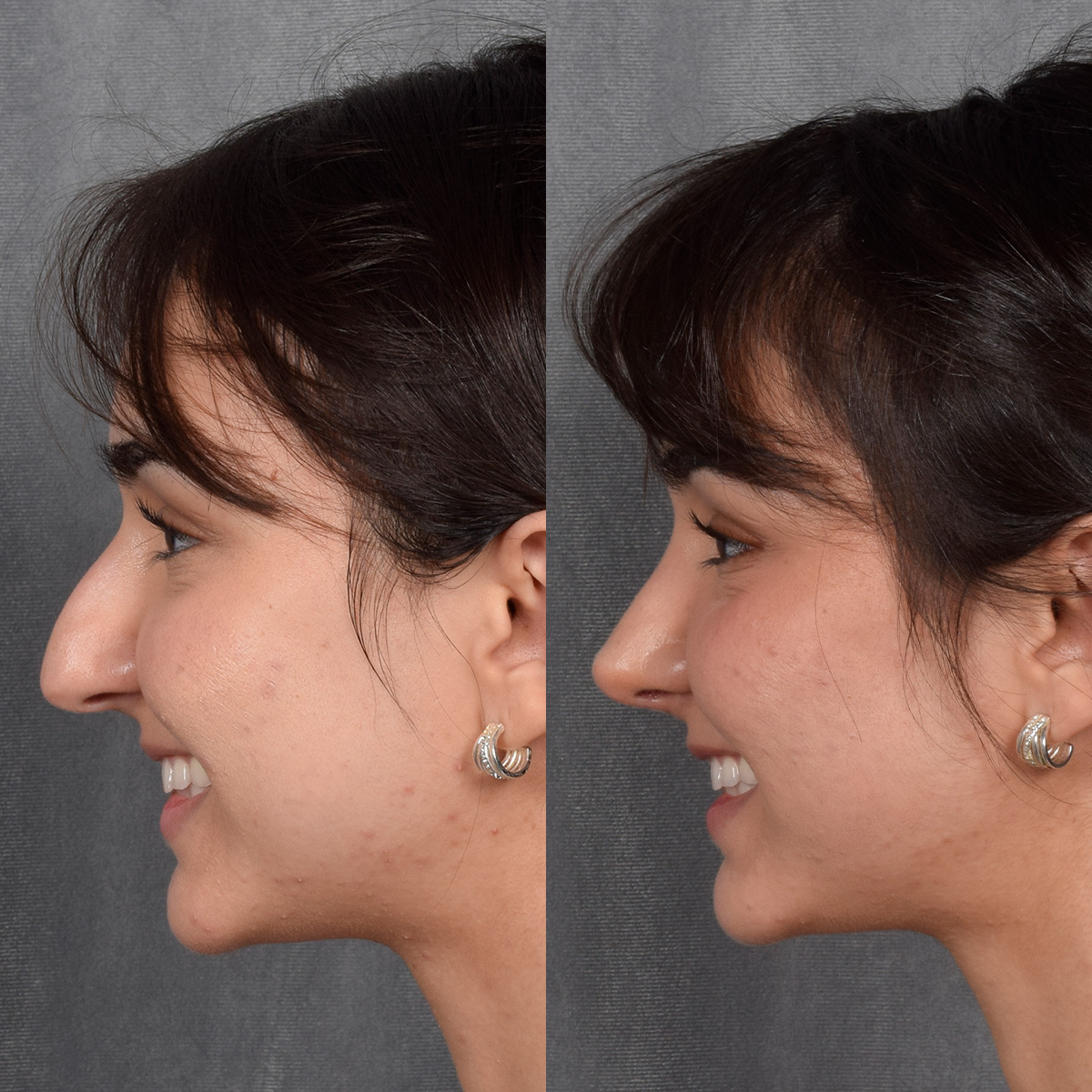 Rhinoplasty Before & After Gallery - Patient 692414 - Image 2