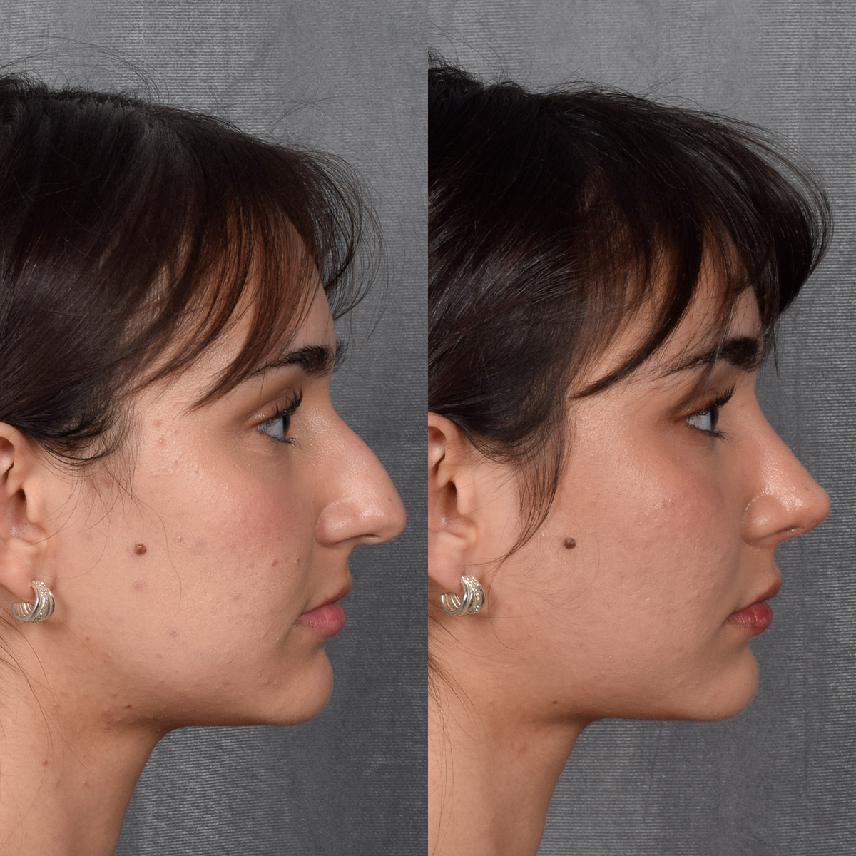 Rhinoplasty Before & After Gallery - Patient 692414 - Image 7