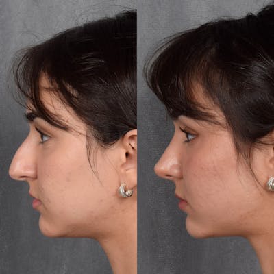 Rhinoplasty Before & After Gallery - Patient 692414 - Image 1