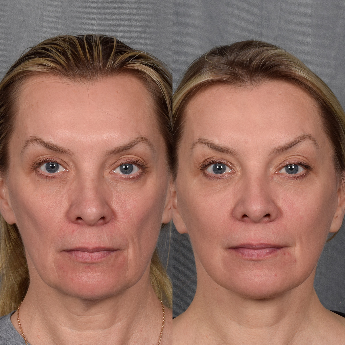 CO2 Laser Before & After Gallery - Patient 381098 - Image 2