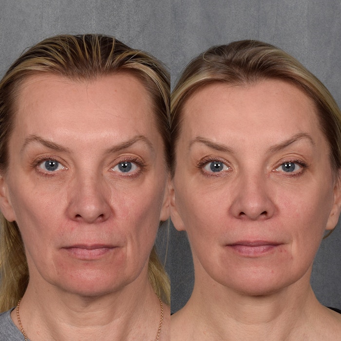 Facelift Before & After Gallery - Patient 365947 - Image 1