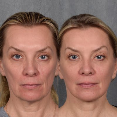 Lower Blepharoplasty Before & After Gallery - Patient 113287 - Image 1