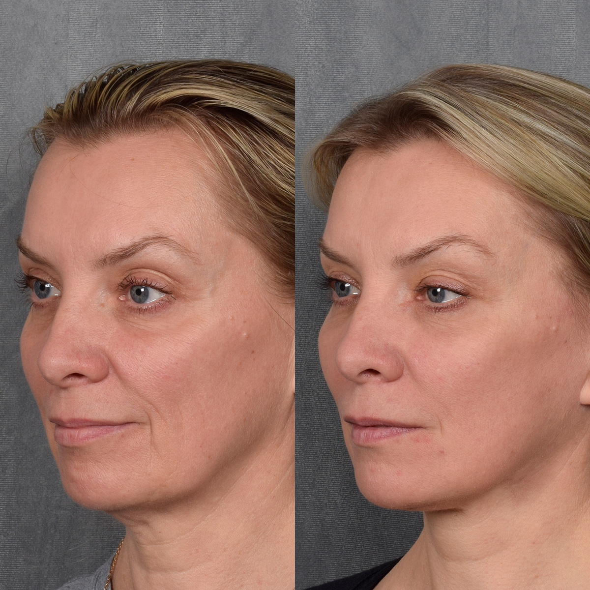 CO2 Laser Before & After Gallery - Patient 381098 - Image 6