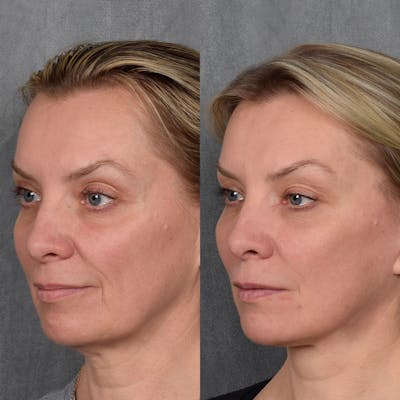 Facelift Before & After Gallery - Patient 365947 - Image 1