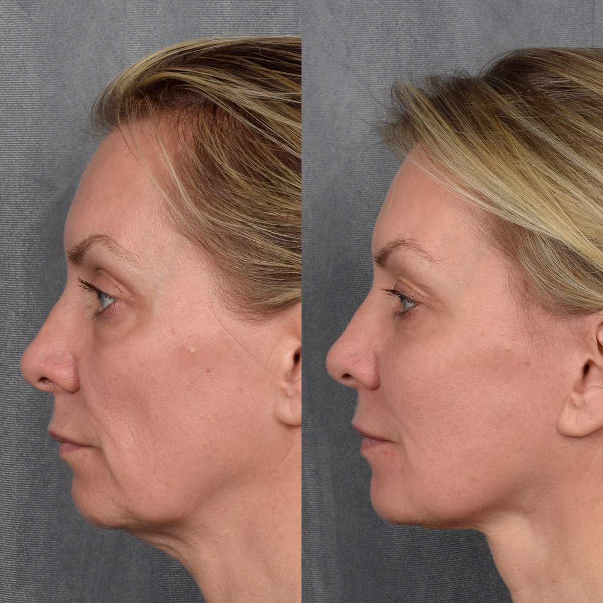 CO2 Laser Before & After Gallery - Patient 381098 - Image 7