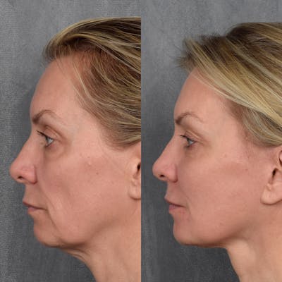 Fat Transfer Before & After Gallery - Patient 242413 - Image 1