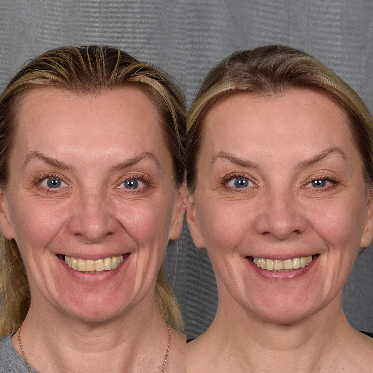 CO2 Laser Before & After Gallery - Patient 381098 - Image 3