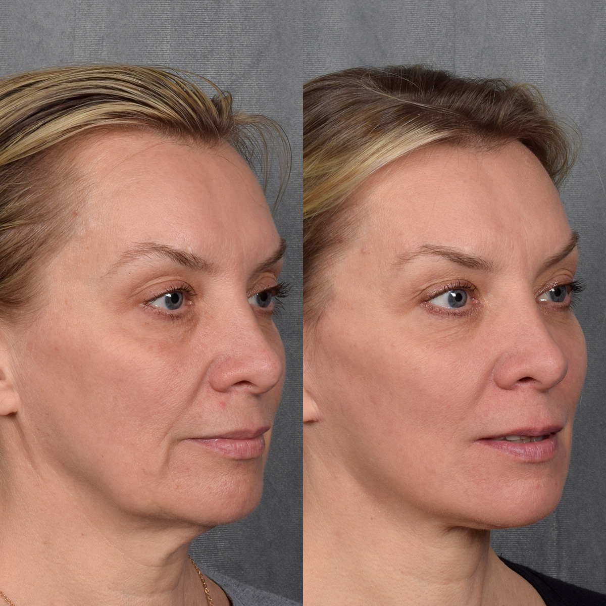 CO2 Laser Before & After Gallery - Patient 381098 - Image 1