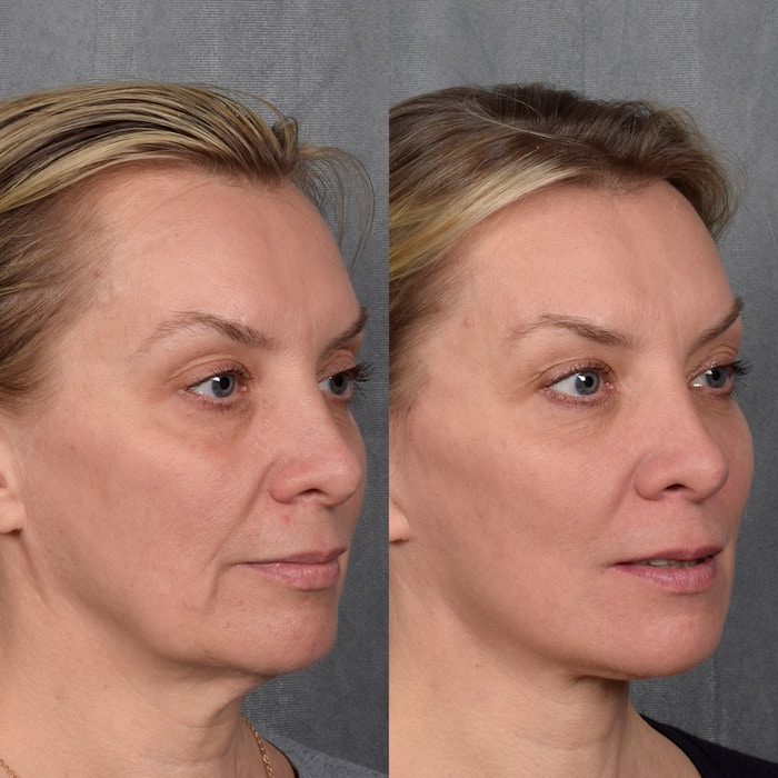 Neck Lift Before & After Gallery - Patient 231918 - Image 1