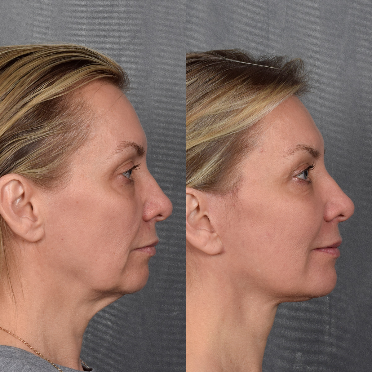 CO2 Laser Before & After Gallery - Patient 381098 - Image 4