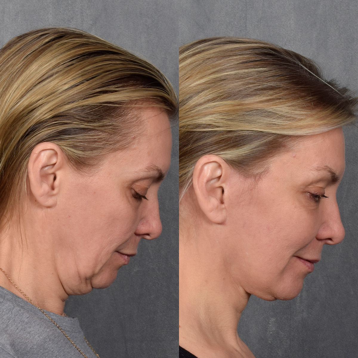 CO2 Laser Before & After Gallery - Patient 381098 - Image 5
