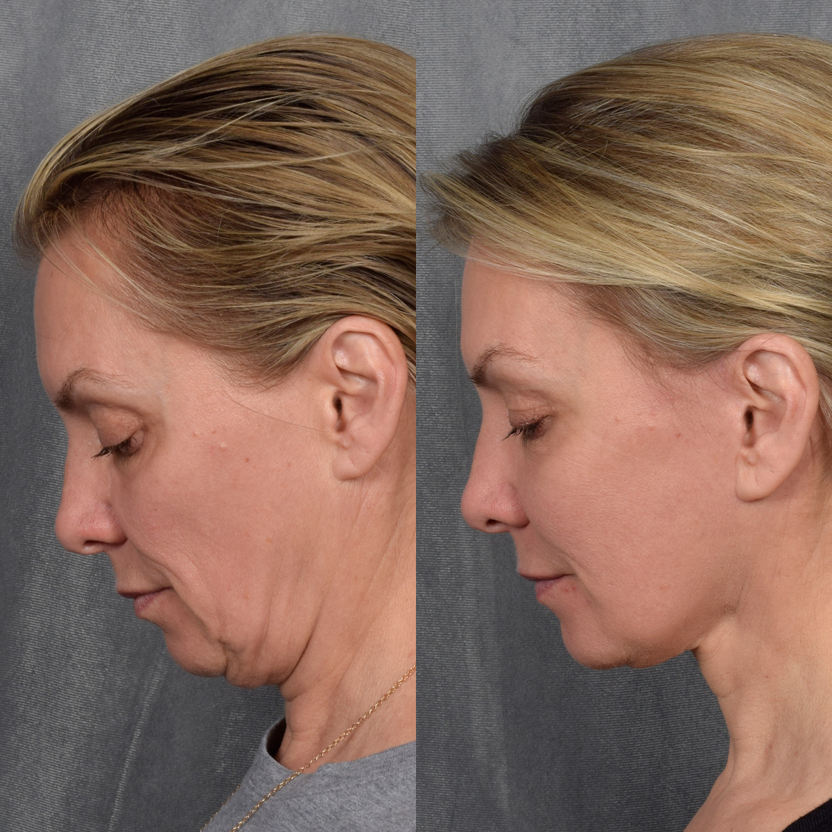 CO2 Laser Before & After Gallery - Patient 381098 - Image 8