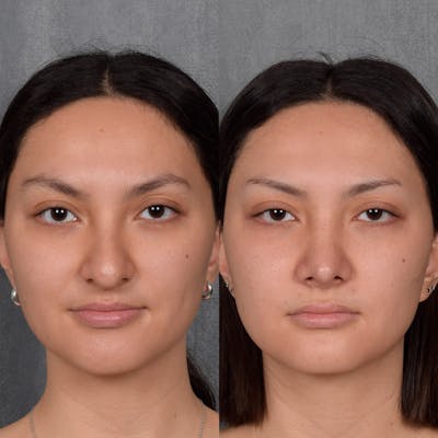 Upper Blepharoplasty Before & After Gallery - Patient 267577 - Image 1