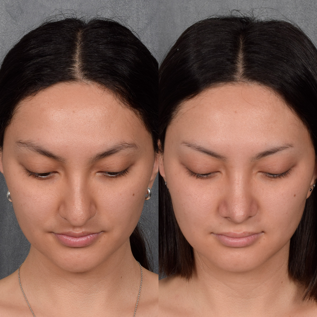 Rhinoplasty Before & After Gallery - Patient 348393 - Image 7