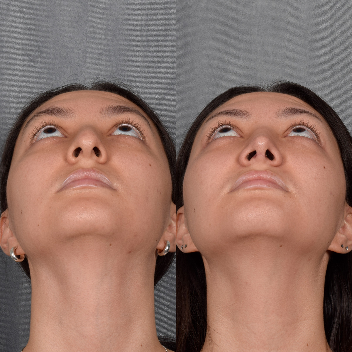 Rhinoplasty Before & After Gallery - Patient 348393 - Image 6