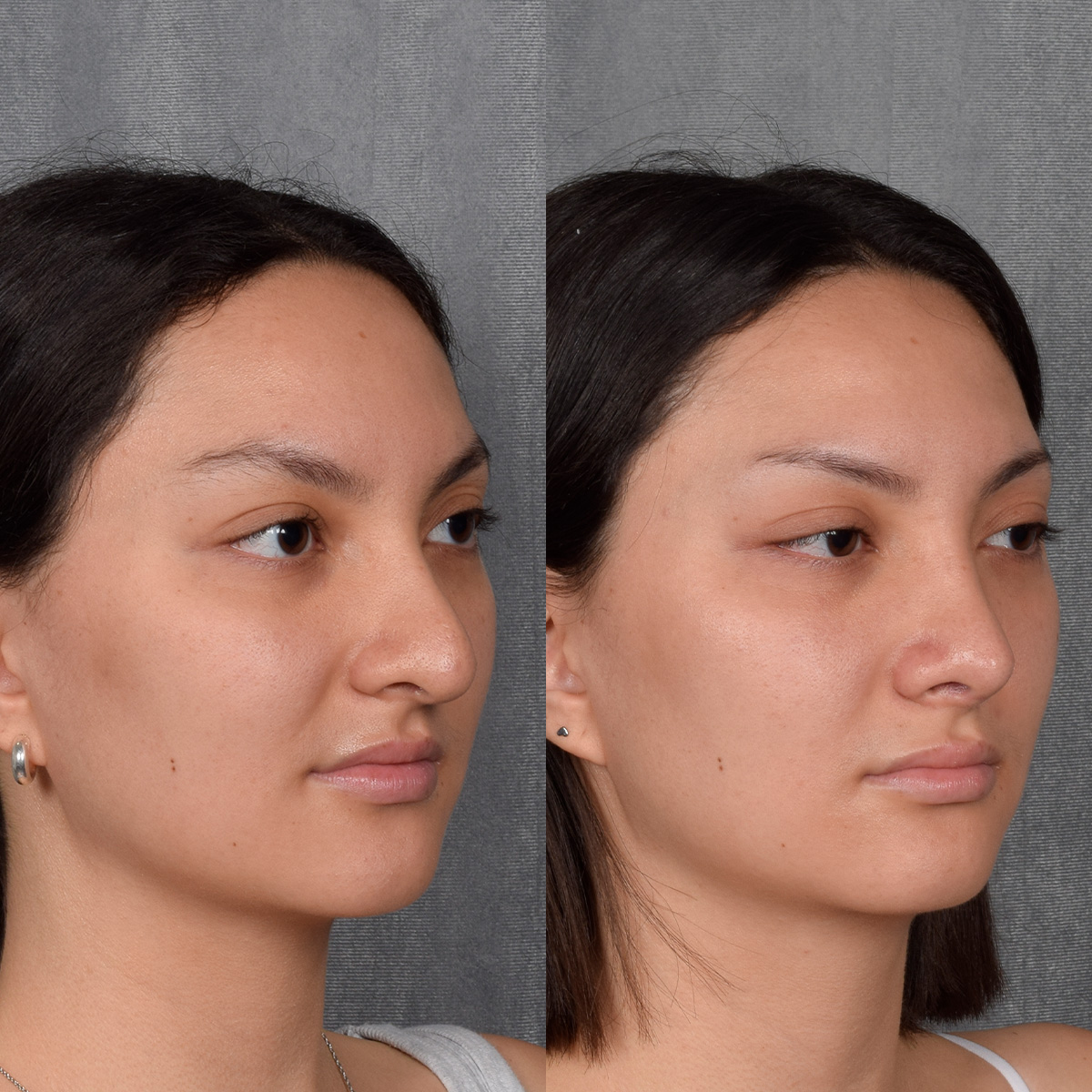 Rhinoplasty Before & After Gallery - Patient 348393 - Image 8