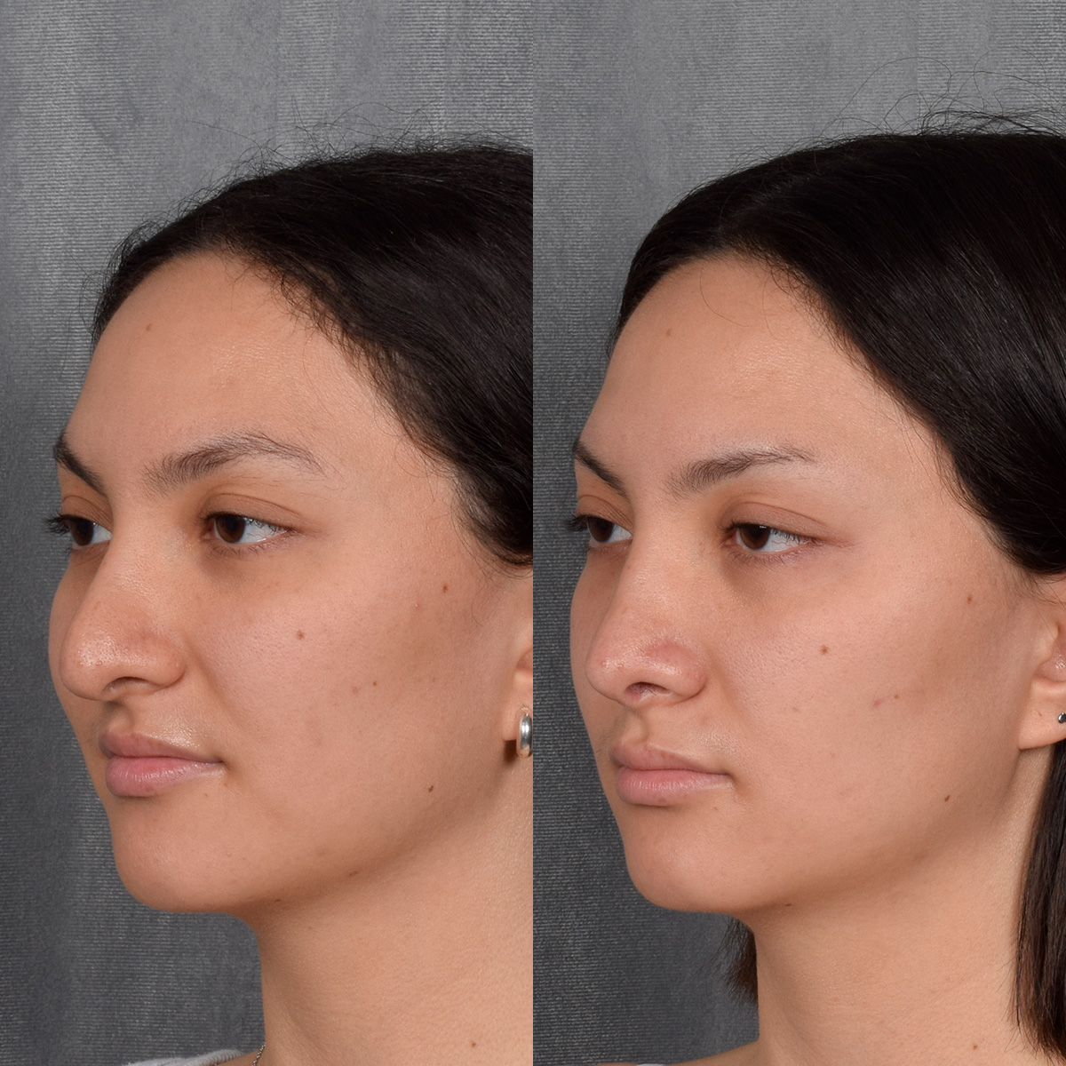 Rhinoplasty Before & After Gallery - Patient 348393 - Image 3