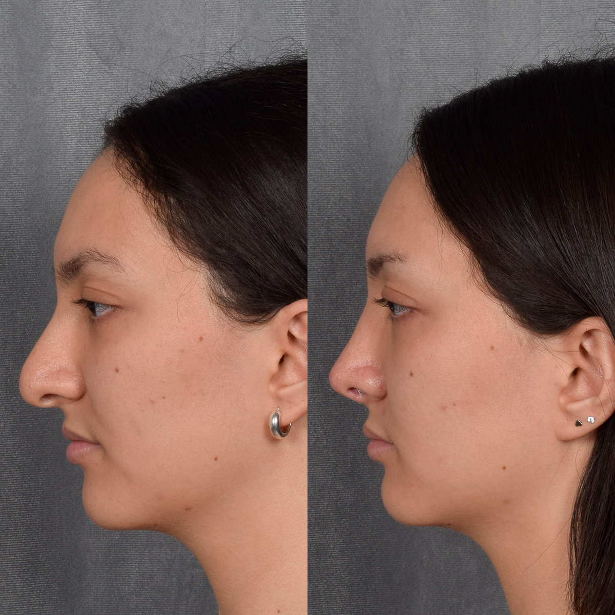 Rhinoplasty Before & After Gallery - Patient 348393 - Image 1