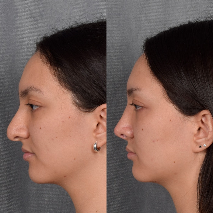 Rhinoplasty Before & After Gallery - Patient 348393 - Image 1