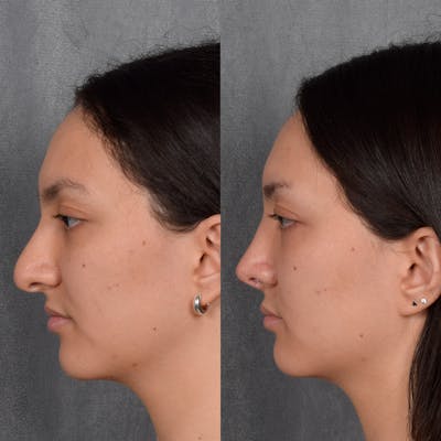 Rhinoplasty Before & After Gallery - Patient 348393 - Image 1