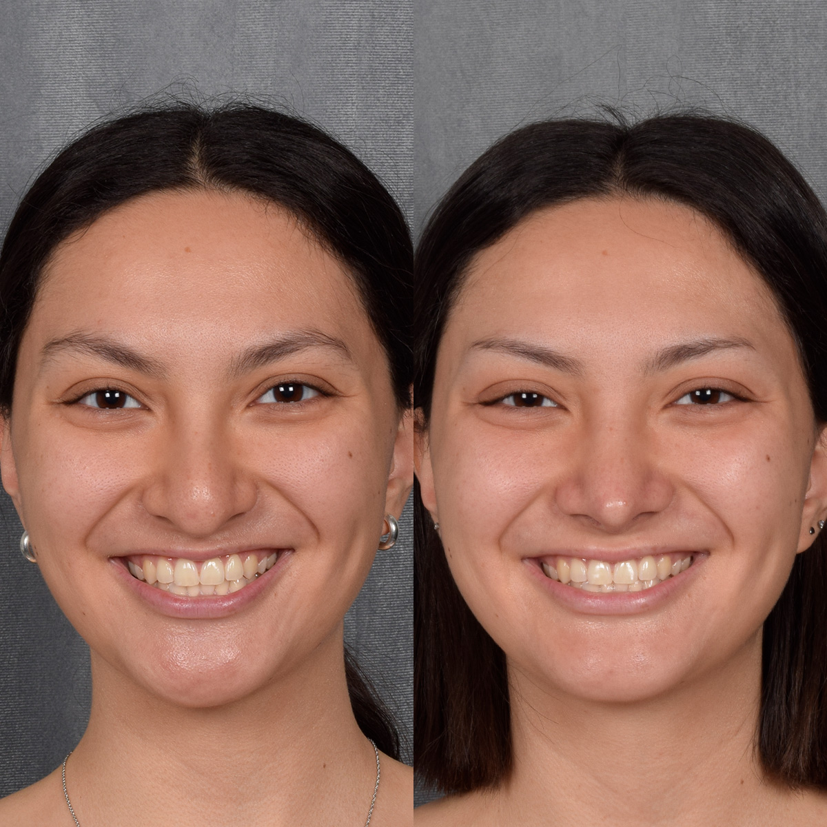 Rhinoplasty Before & After Gallery - Patient 348393 - Image 5