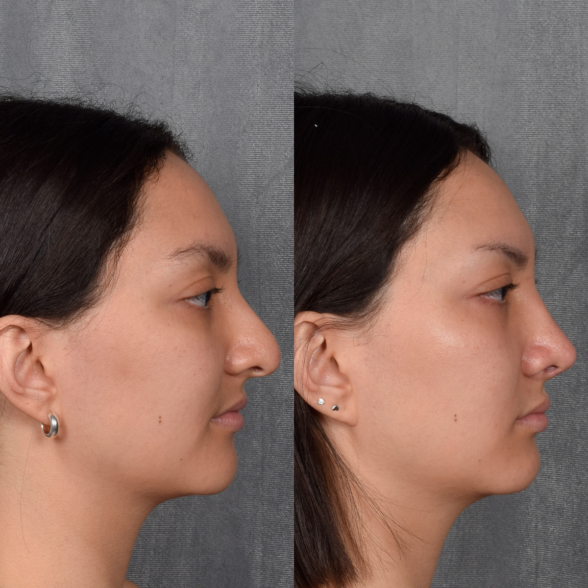 Rhinoplasty Before & After Gallery - Patient 348393 - Image 9
