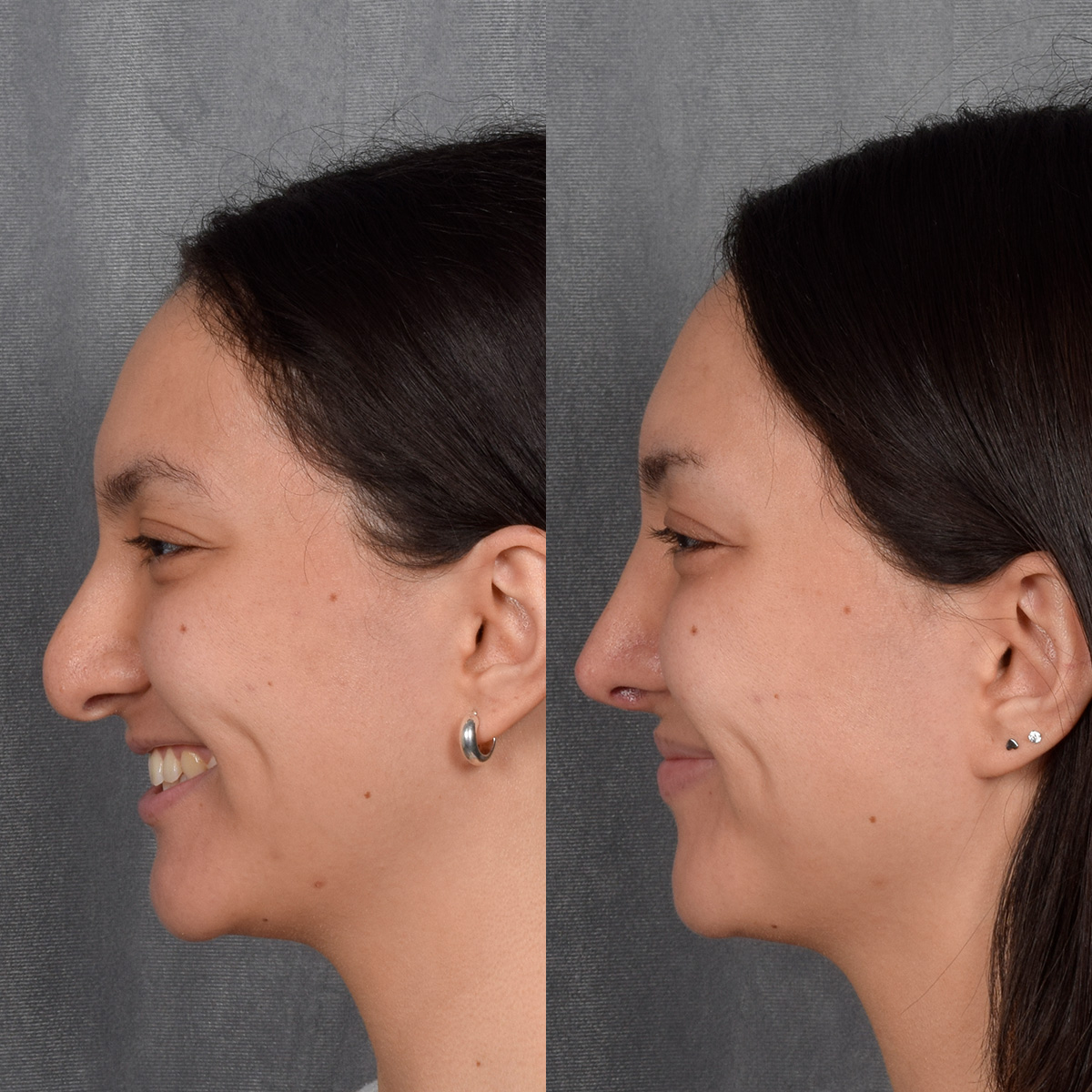 Rhinoplasty Before & After Gallery - Patient 348393 - Image 2