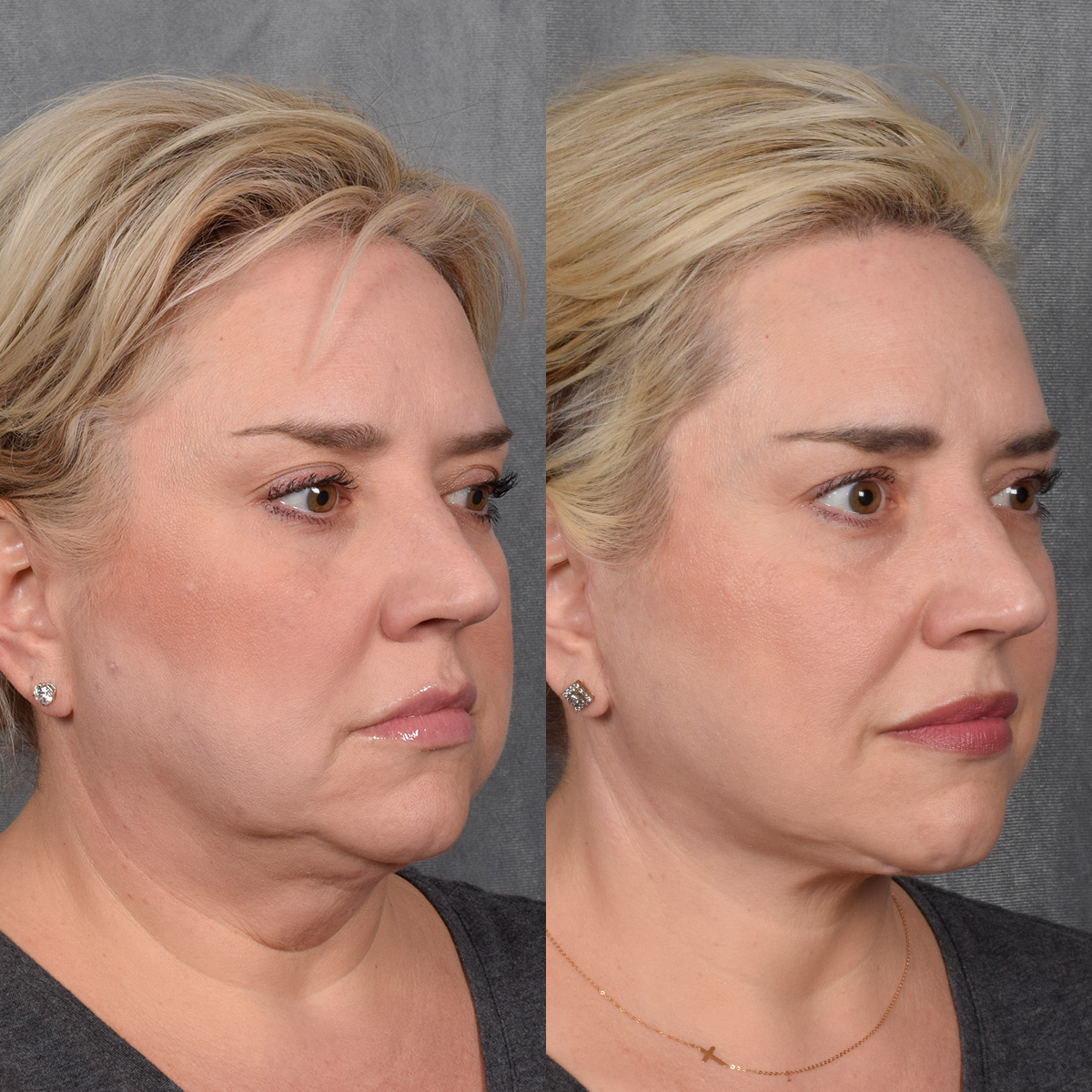 Rhinoplasty Before & After Gallery - Patient 231813 - Image 5
