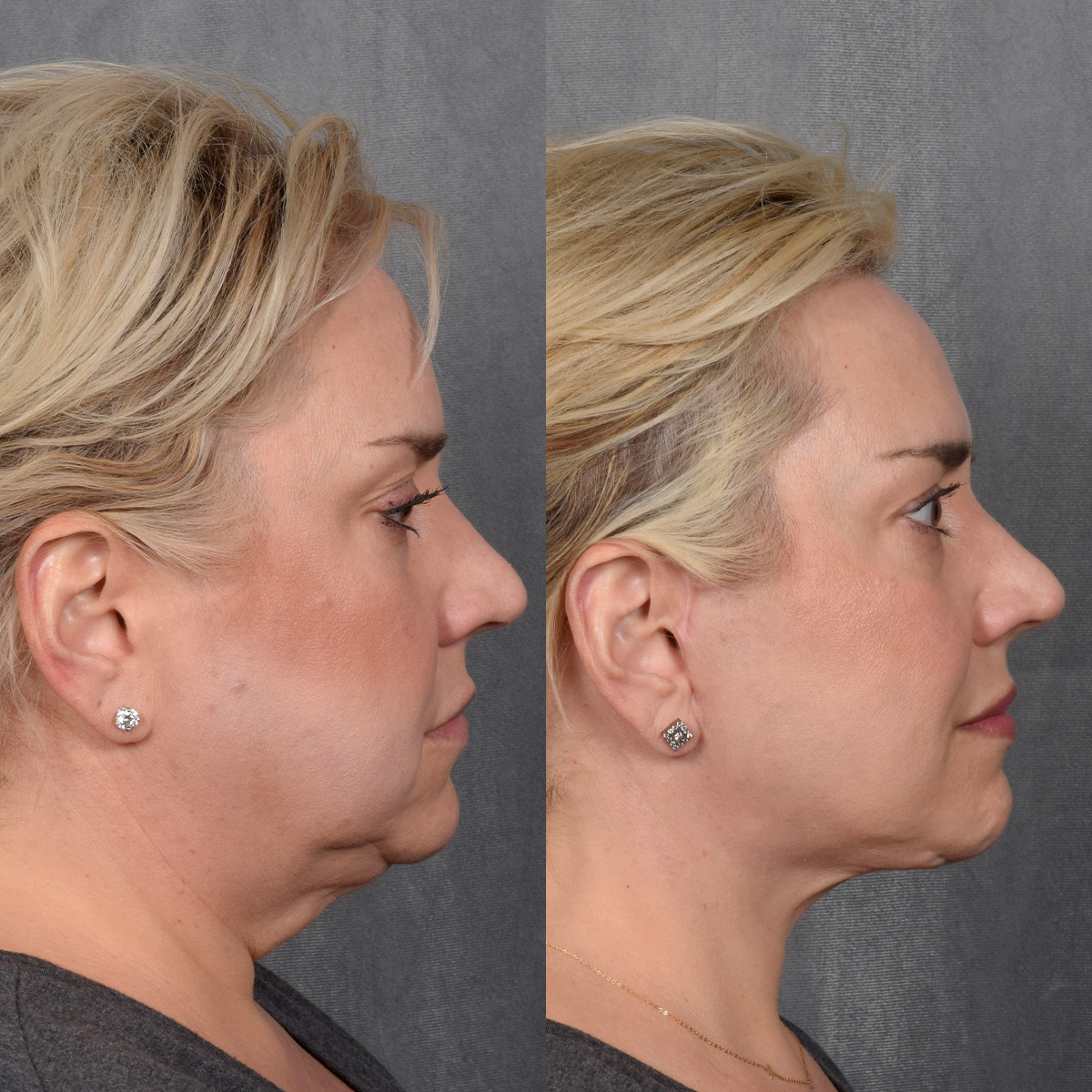 Rhinoplasty Before & After Gallery - Patient 231813 - Image 7