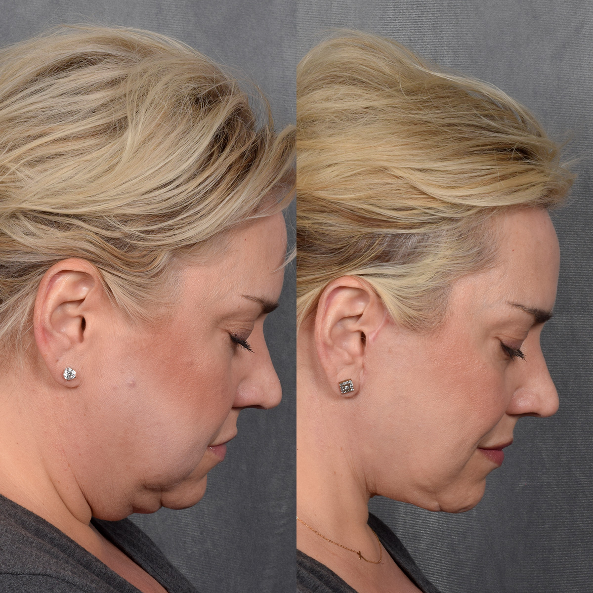 Rhinoplasty Before & After Gallery - Patient 231813 - Image 6