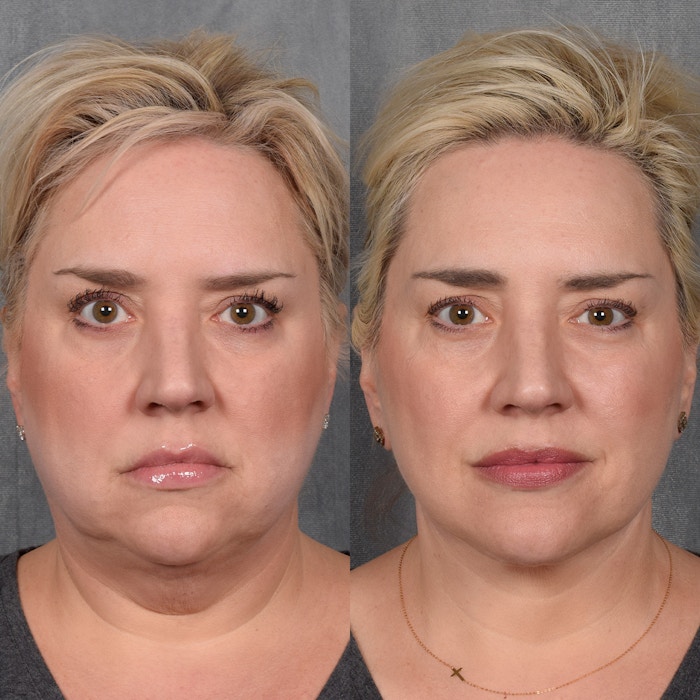 Facelift Before & After Gallery - Patient 215374 - Image 1