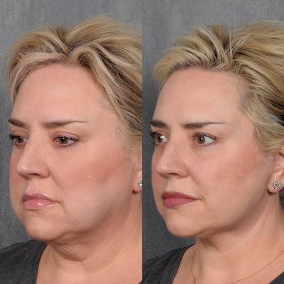 Facelift Before & After Gallery - Patient 215374 - Image 1