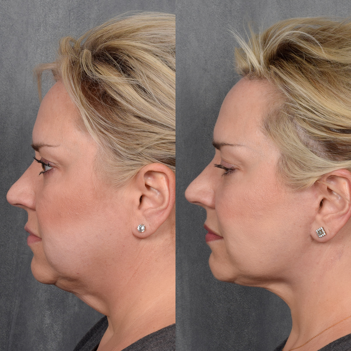 Rhinoplasty Before & After Gallery - Patient 231813 - Image 1