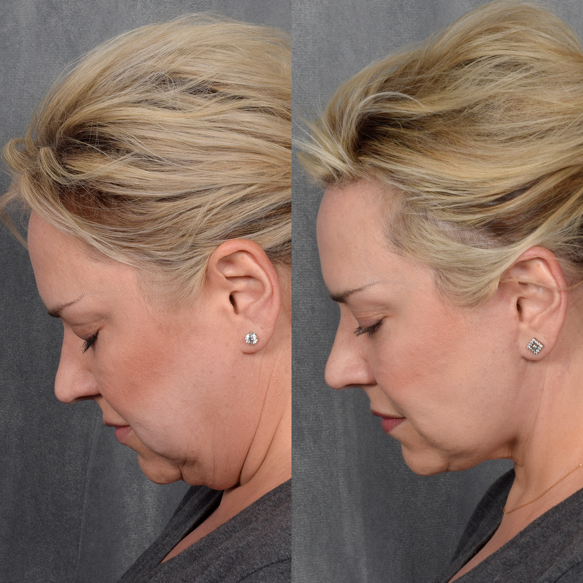Rhinoplasty Before & After Gallery - Patient 231813 - Image 2