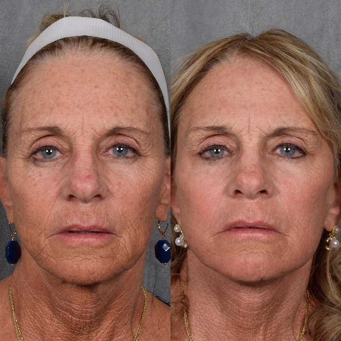 Brow Lift Before & After Gallery - Patient 399644 - Image 1