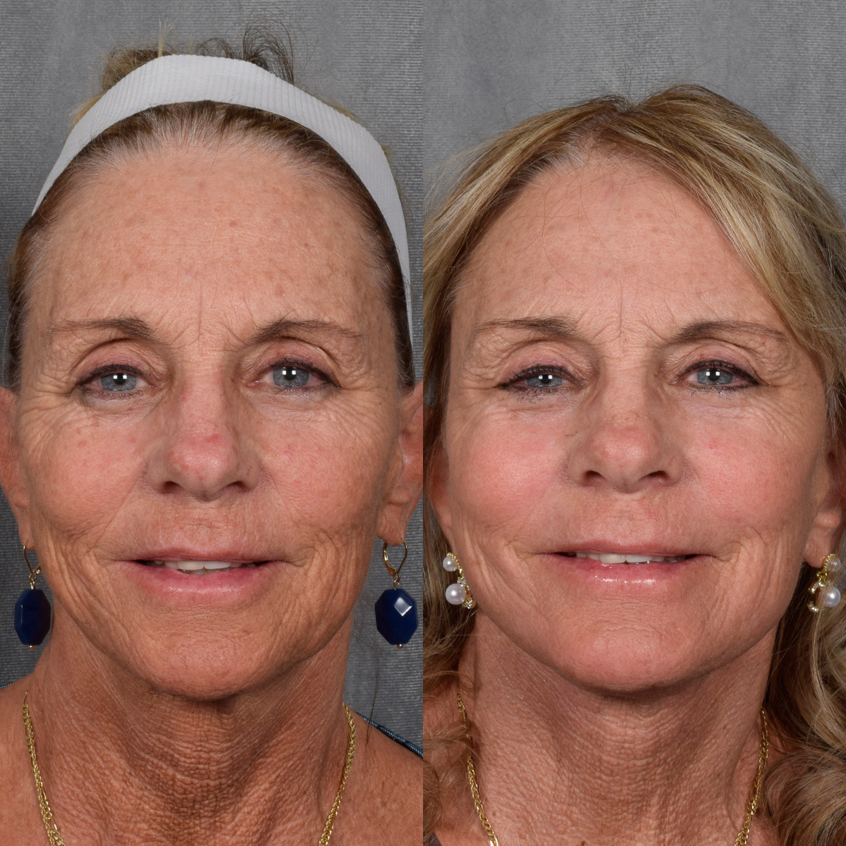 Facelift Before & After Gallery - Patient 640503 - Image 2