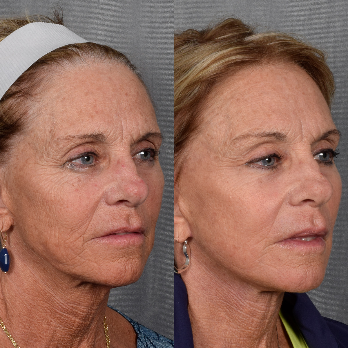 Facelift Before & After Gallery - Patient 640503 - Image 3