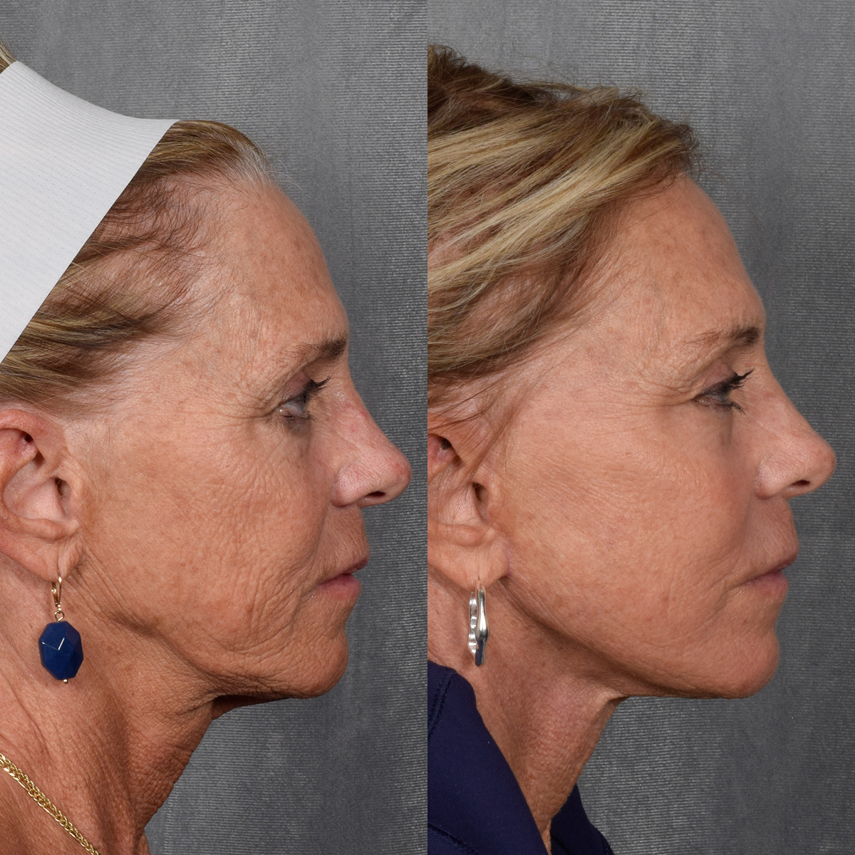 Facelift Before & After Gallery - Patient 640503 - Image 4