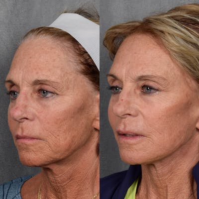Facelift Before & After Gallery - Patient 640503 - Image 1