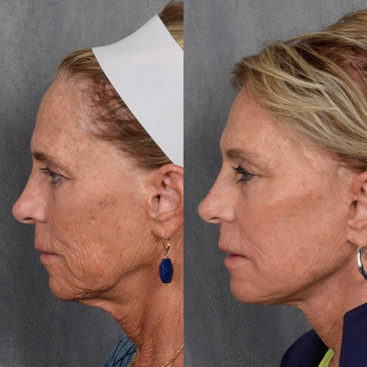 Facelift Before & After Gallery - Patient 640503 - Image 7