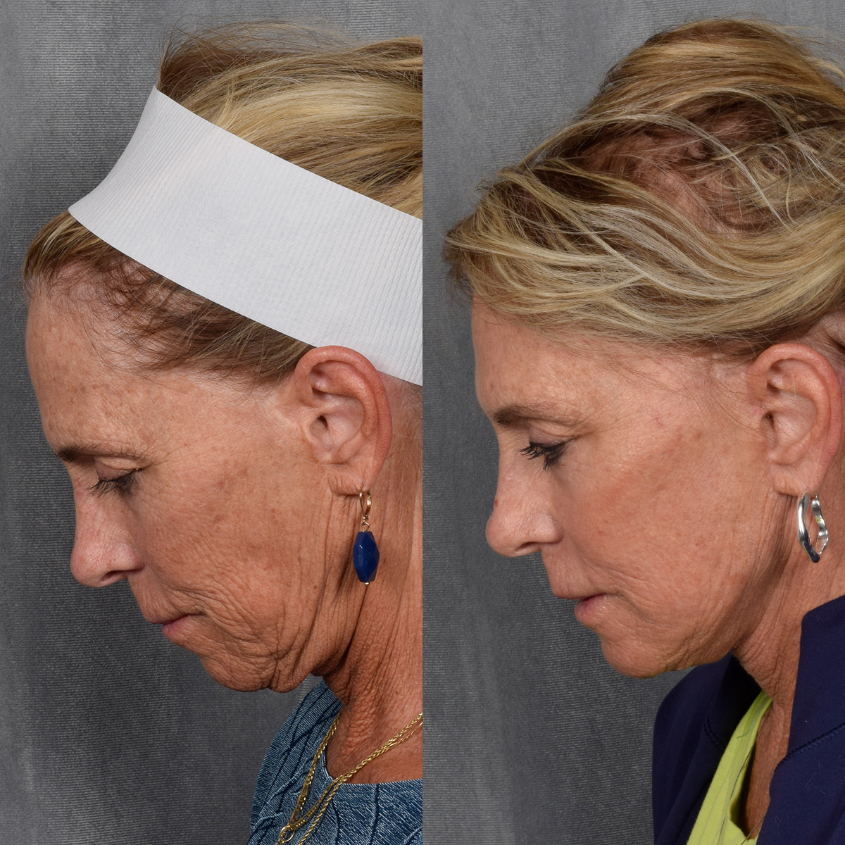 Facelift Before & After Gallery - Patient 640503 - Image 8