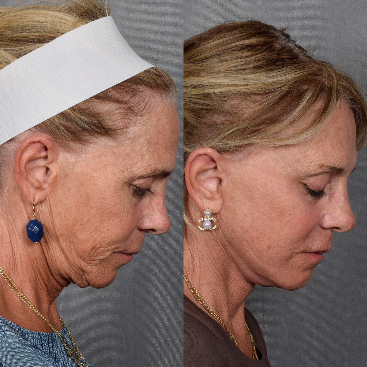 Facelift Before & After Gallery - Patient 640503 - Image 5