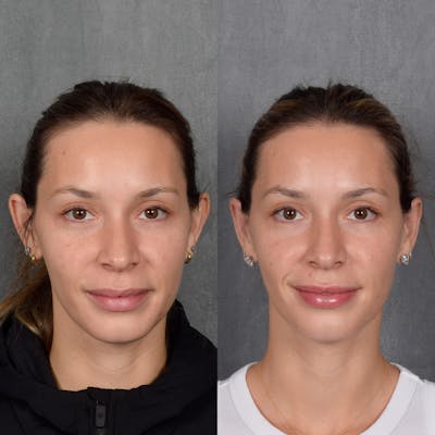 Otoplasty Before & After Gallery - Patient 128122 - Image 1