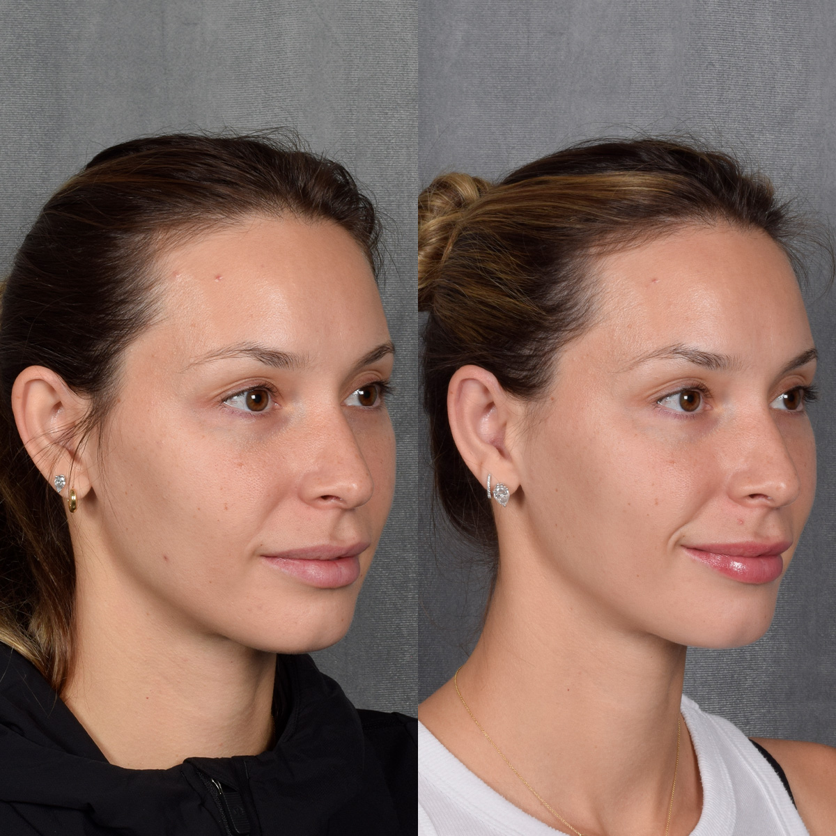 Otoplasty Before & After Gallery - Patient 128122 - Image 2