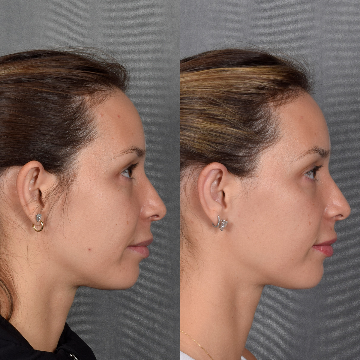 Otoplasty Before & After Gallery - Patient 128122 - Image 3