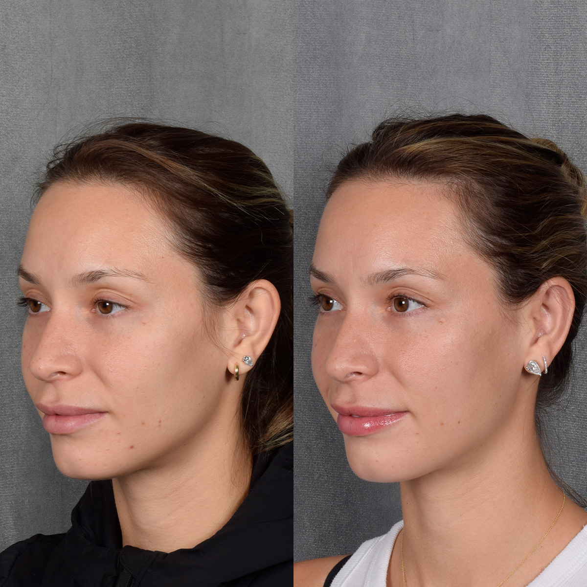 Otoplasty Before & After Gallery - Patient 128122 - Image 4