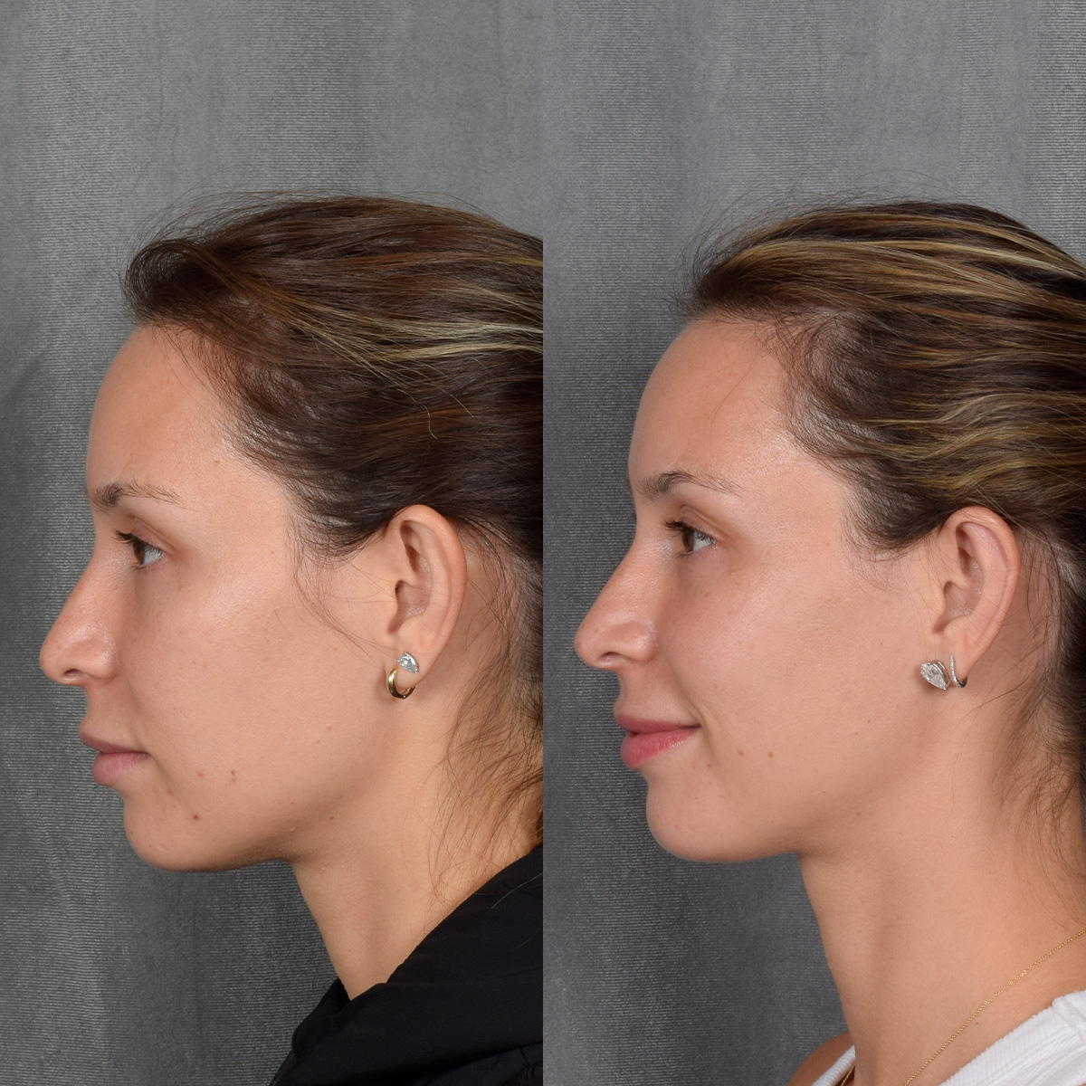 Otoplasty Before & After Gallery - Patient 128122 - Image 5