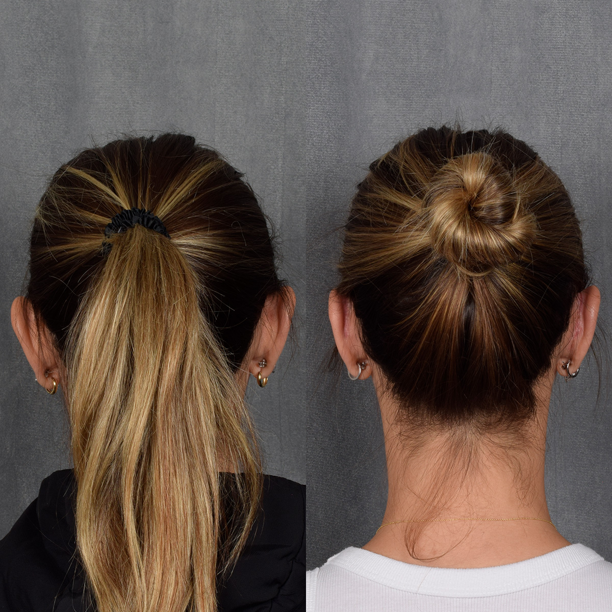 Otoplasty Before & After Gallery - Patient 128122 - Image 6