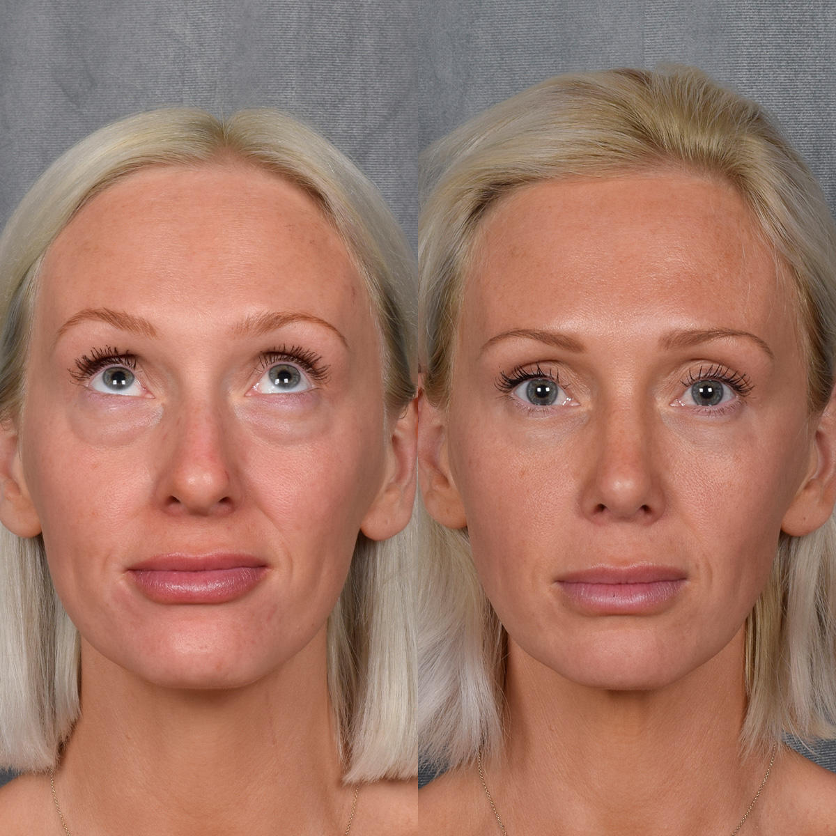 Rhinoplasty Before & After Gallery - Patient 404147 - Image 4